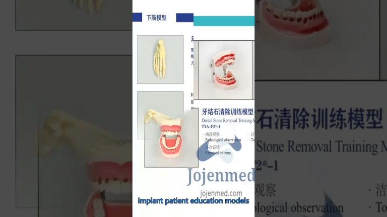 Dental Onlay Inlay Modell Implantat Krone Brücke China Hersteller, China anpassen.